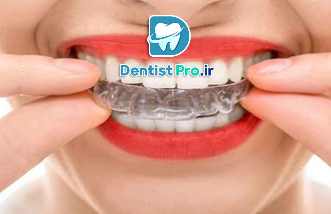 ارتودنسی شفاف بدون دیده شدن براکت ها در لبخند: راهنمای کامل برای لبخند زیبا 25 ارتودنسی شفاف بدون دیده شدن براکت ها در لبخند: راهنمای کامل برای لبخند زیبا