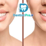 بستن فاصله دو دندان جلو با کامپوزیت