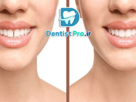 بستن فاصله دو دندان جلو با کامپوزیت