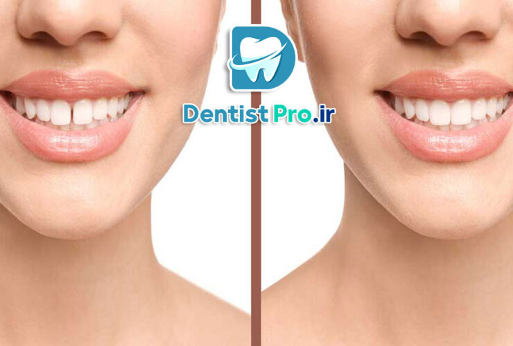 بستن فاصله دو دندان جلو با کامپوزیت