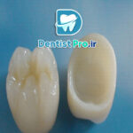 مقایسه روکش سرامیکی و زیرکونیا از نظر زیبایی