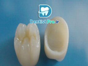 مقایسه روکش سرامیکی و زیرکونیا از نظر زیبایی
