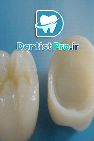 مقایسه روکش سرامیکی و زیرکونیا از نظر زیبایی