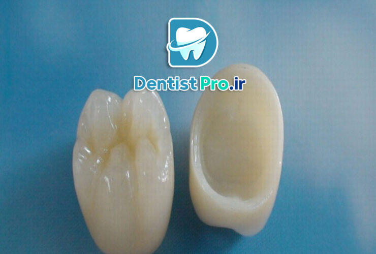 مقایسه روکش سرامیکی و زیرکونیا از نظر زیبایی