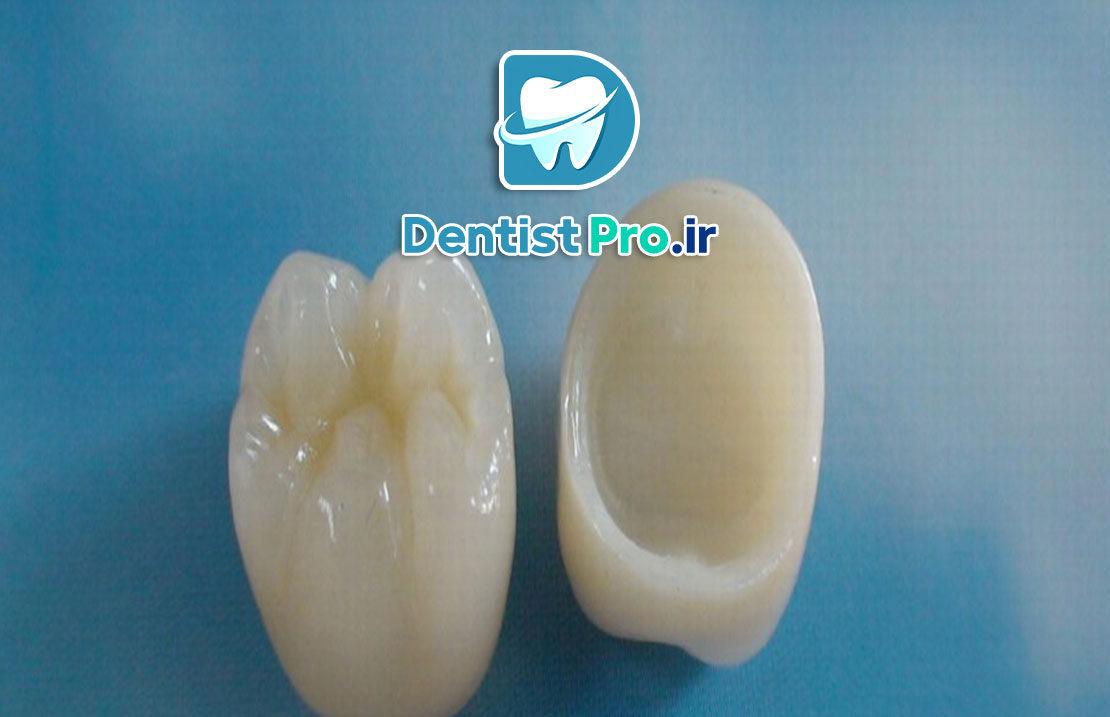 مقایسه روکش سرامیکی و زیرکونیا از نظر زیبایی