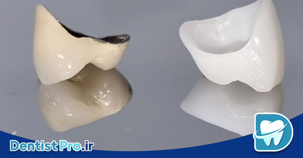 مقایسه روکش سرامیکی و زیرکونیا از نظر زیبایی