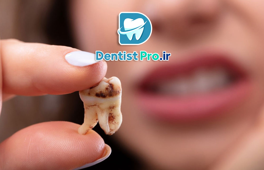 برنامه کامل مراقبت از دندان برای جلوگیری از پوسیدگی