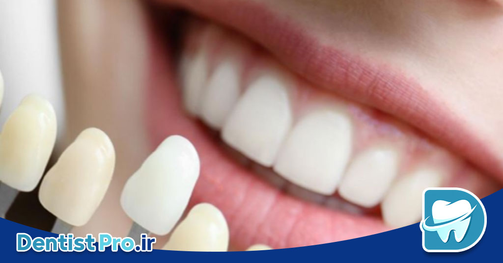 قیمت کامپوزیت ونیر هر دندان در تهران 26 قیمت کامپوزیت ونیر هر دندان در تهران