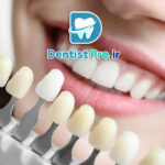 قیمت کامپوزیت ونیر هر دندان در تهران