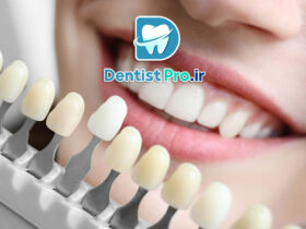 قیمت کامپوزیت ونیر هر دندان در تهران