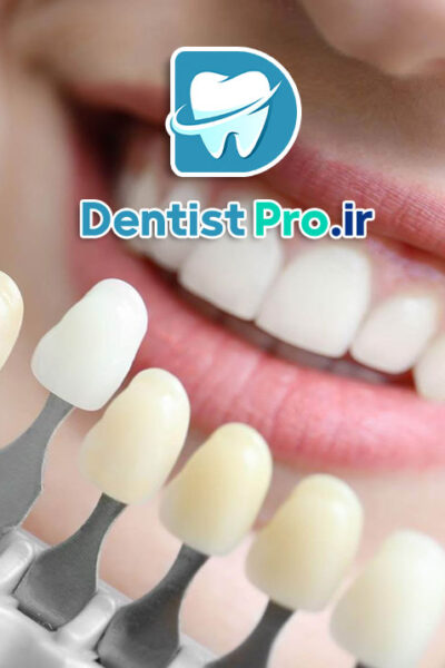 قیمت کامپوزیت ونیر هر دندان در تهران