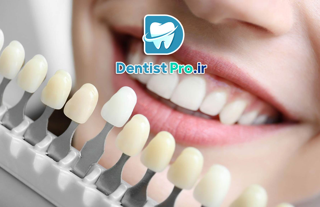 قیمت کامپوزیت ونیر هر دندان در تهران 25 قیمت کامپوزیت ونیر هر دندان در تهران
