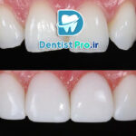 کامپوزیت با خط لثه نامنظم+بررسی روشهای 100%کارآمد