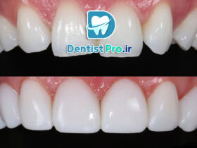 کامپوزیت با خط لثه نامنظم+بررسی روشهای 100%کارآمد