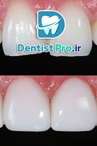کامپوزیت با خط لثه نامنظم+بررسی روشهای 100%کارآمد