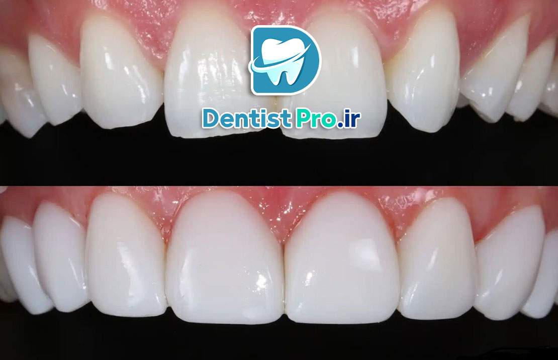 کامپوزیت با خط لثه نامنظم+بررسی روشهای 100%کارآمد