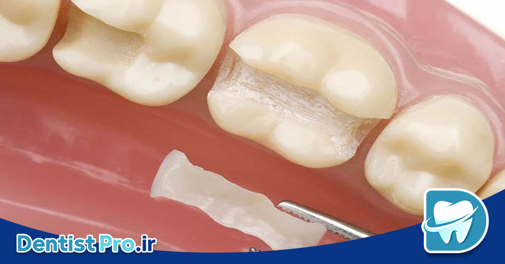 کامپوزیت با خط لثه نامنظم+بررسی روشهای 100%کارآمد