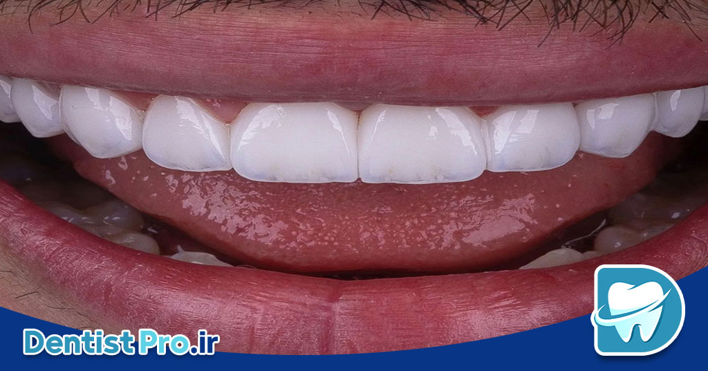 کامپوزیت محافظه کارانه بدون تغییر حجم لب