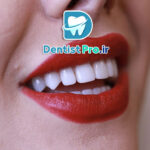 کامپوزیت محافظه کارانه بدون تغییر حجم لب