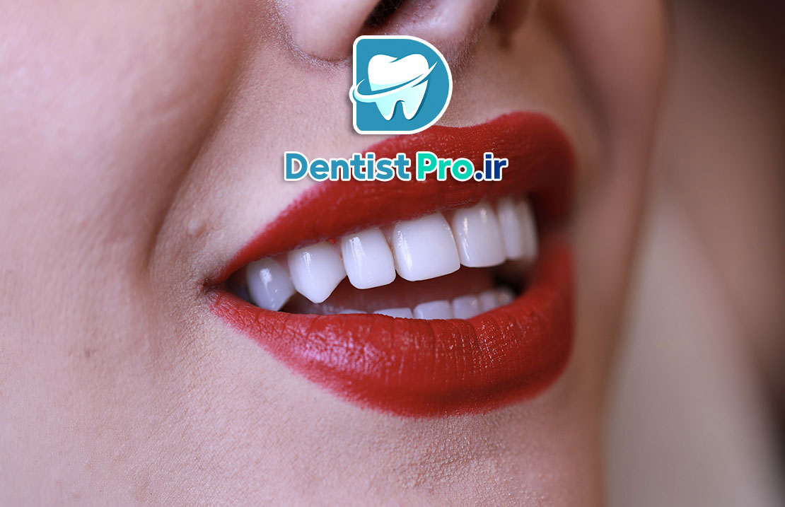 کامپوزیت محافظه کارانه بدون تغییر حجم لب