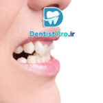 اصلاح دندان های کج خفیف با لمینت