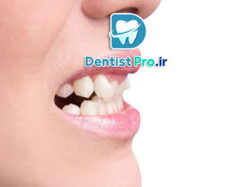 اصلاح دندان های کج خفیف با لمینت