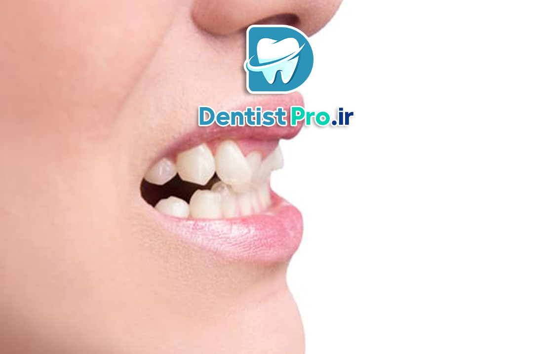 اصلاح دندان های کج خفیف با لمینت 25 اصلاح دندان های کج خفیف با لمینت