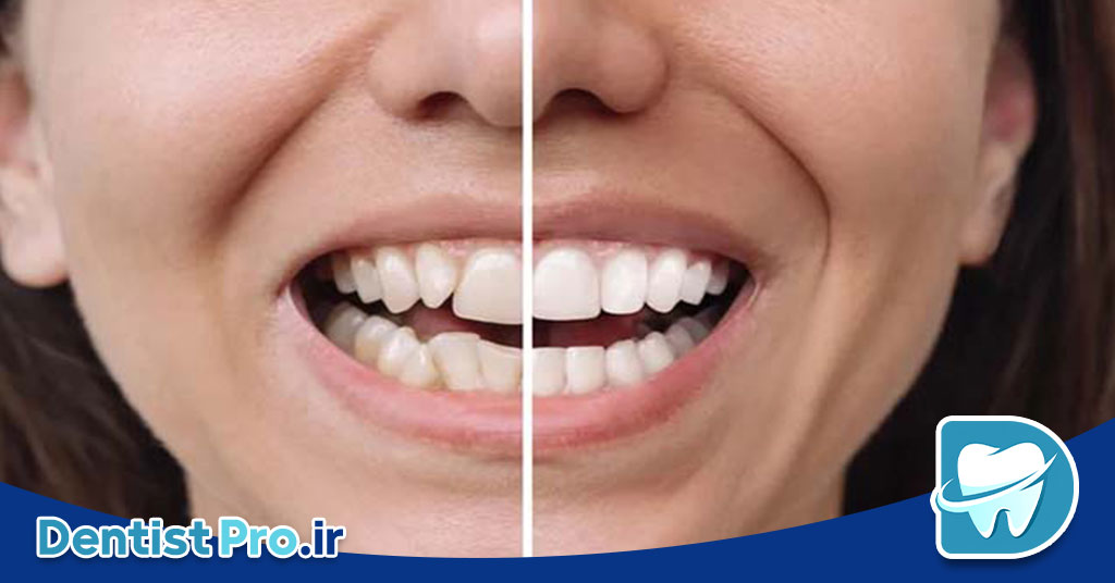 اصلاح دندان های کج خفیف با لمینت 26 اصلاح دندان های کج خفیف با لمینت