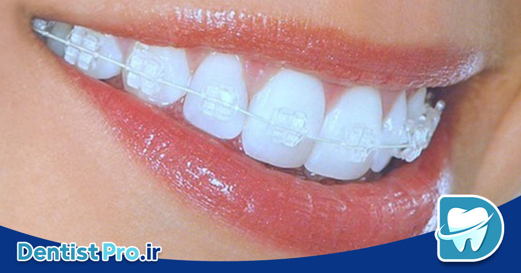 اصلاح فاصله دندان جلو بدون ارتودنسی ثابت