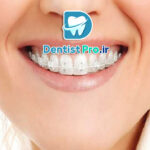 اصلاح فاصله دندان جلو بدون ارتودنسی ثابت