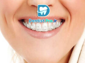 اصلاح فاصله دندان جلو بدون ارتودنسی ثابت