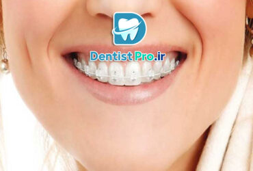 اصلاح فاصله دندان جلو بدون ارتودنسی ثابت