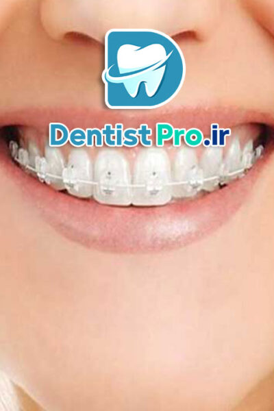 اصلاح فاصله دندان جلو بدون ارتودنسی ثابت