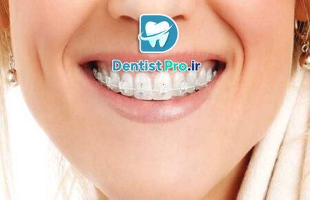 اصلاح فاصله دندان جلو بدون ارتودنسی ثابت