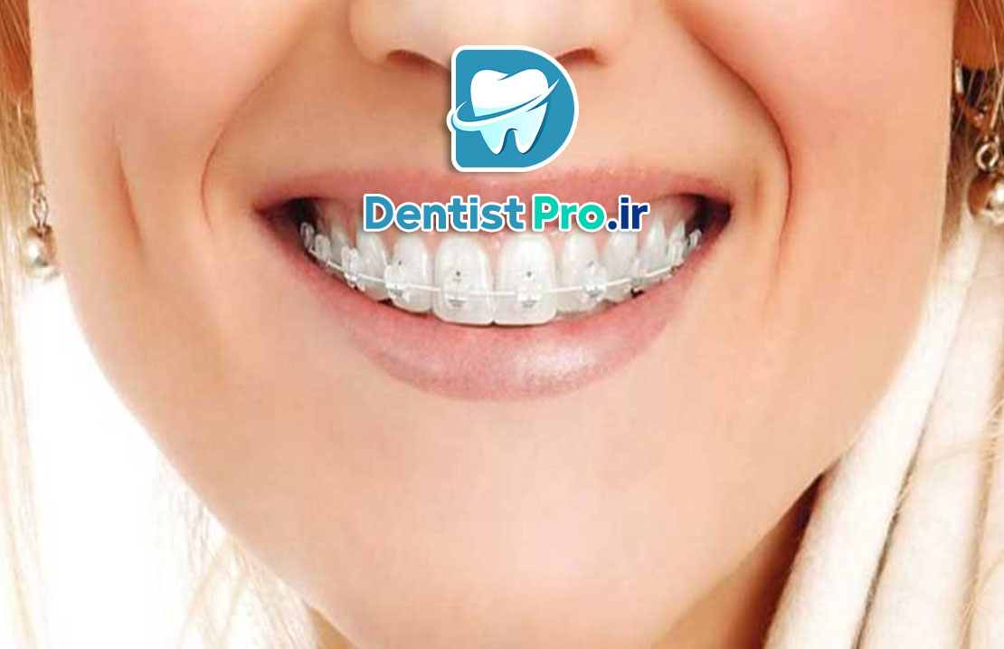 اصلاح فاصله دندان جلو بدون ارتودنسی ثابت