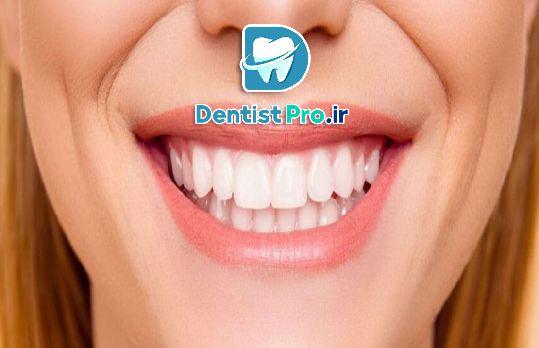 اصلاح خط لبخند ناهماهنگ بدون ارتودنسی 25 اصلاح خط لبخند ناهماهنگ بدون ارتودنسی