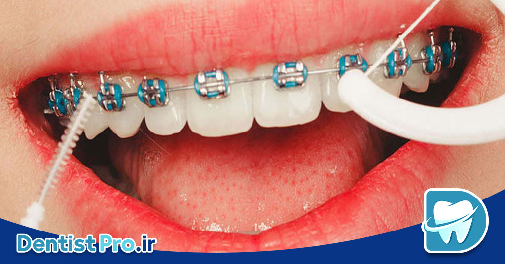 اصلاح خط لبخند ناهماهنگ بدون ارتودنسی 26 اصلاح خط لبخند ناهماهنگ بدون ارتودنسی