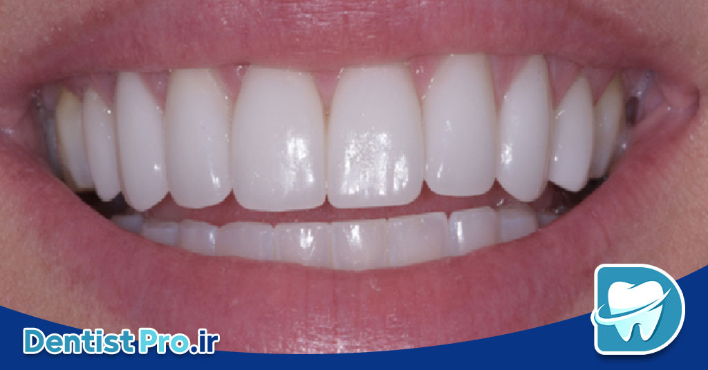 پرکردگی زیبایی برای دندان های جلو
