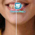 پرکردگی زیبایی برای دندان های جلو