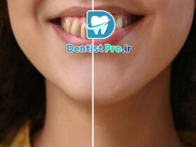 پرکردگی زیبایی برای دندان های جلو