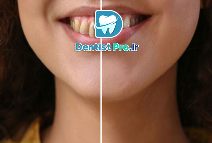 پرکردگی زیبایی برای دندان های جلو 35 پرکردگی زیبایی برای دندان های جلو