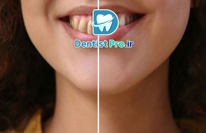 پرکردگی زیبایی برای دندان های جلو