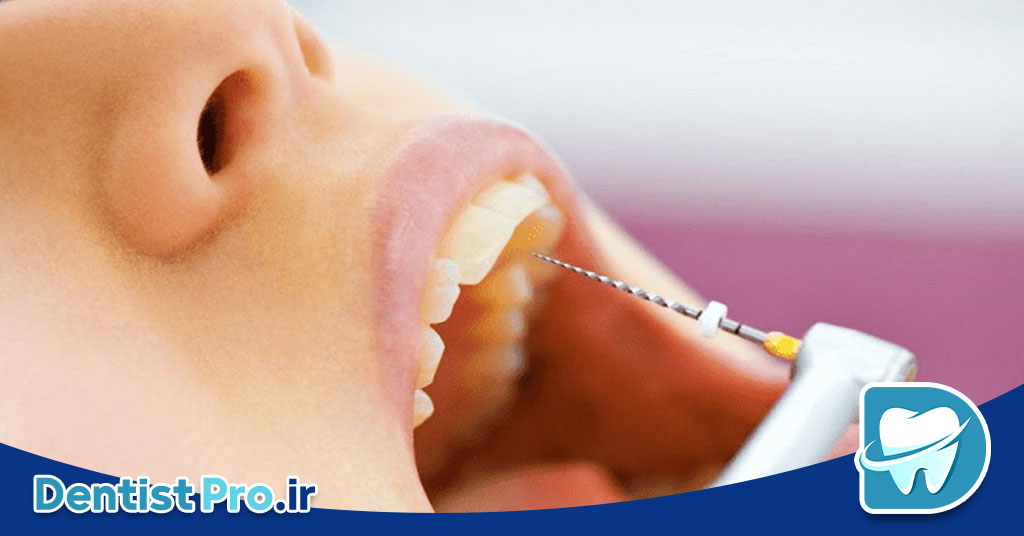 هزینه عصب کشی دندان مولر