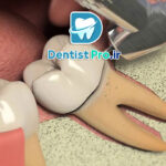 هزینه عصب کشی دندان مولر