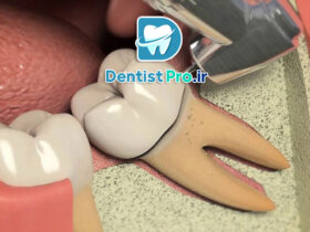 هزینه عصب کشی دندان مولر