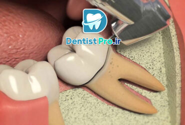 هزینه عصب کشی دندان مولر