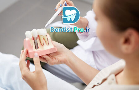 هزینه ایمپلنت یک روزه با جراحی بدون برش لثه