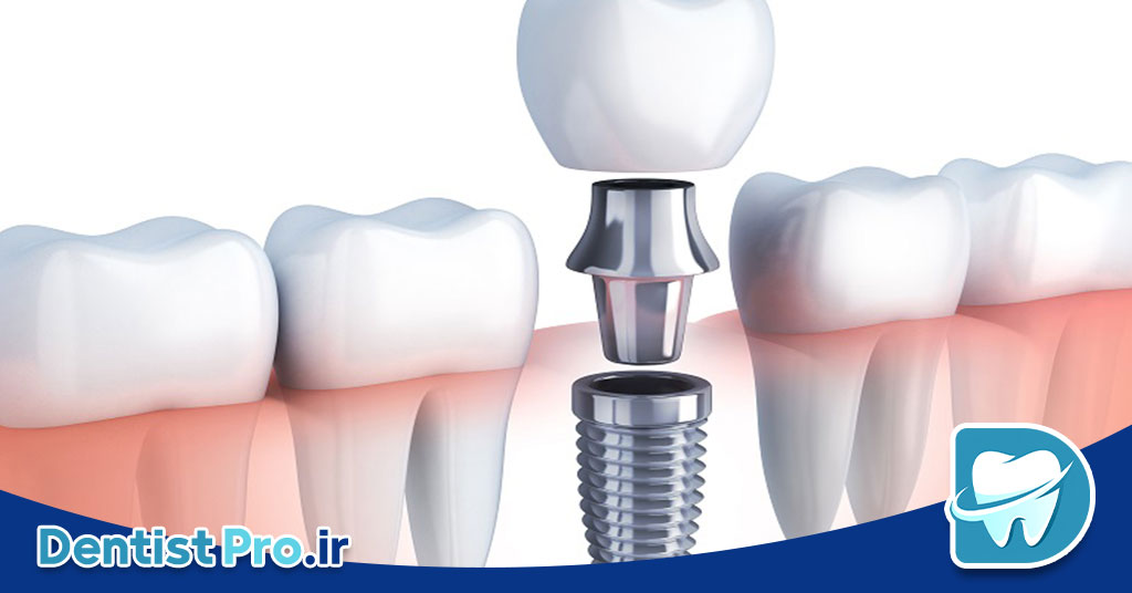 هزینه ایمپلنت یک روزه با جراحی بدون برش لثه 26 هزینه ایمپلنت یک روزه با جراحی بدون برش لثه