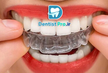 هزینه ارتودنسی نامرئی با کیفیت