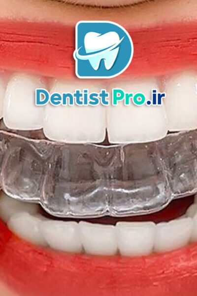 هزینه ارتودنسی نامرئی با کیفیت